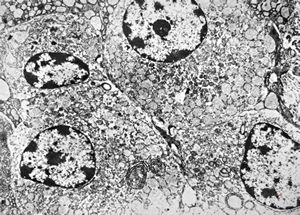 stomach- plasmocytoma stomach- plasmocytoma